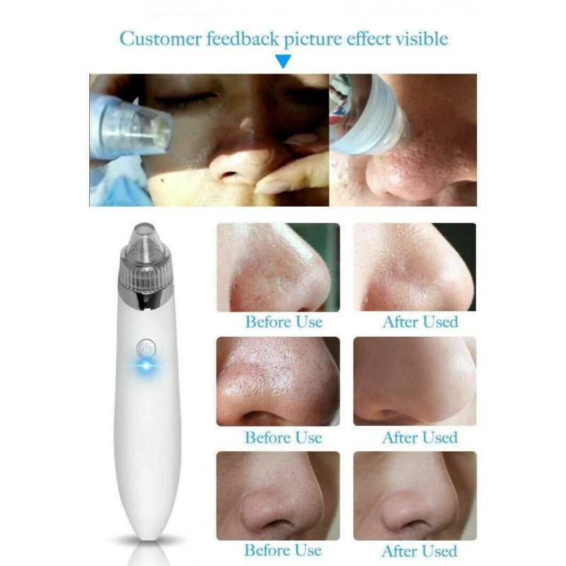 Aspiratore punti neri viso pulizia benessere rimuovi sporcizia pelle