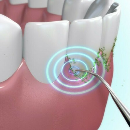 Sonic Pic Dispositivo Pulizia denti 3000 Vibrazioni Ablatore Sbiancante Tartaro