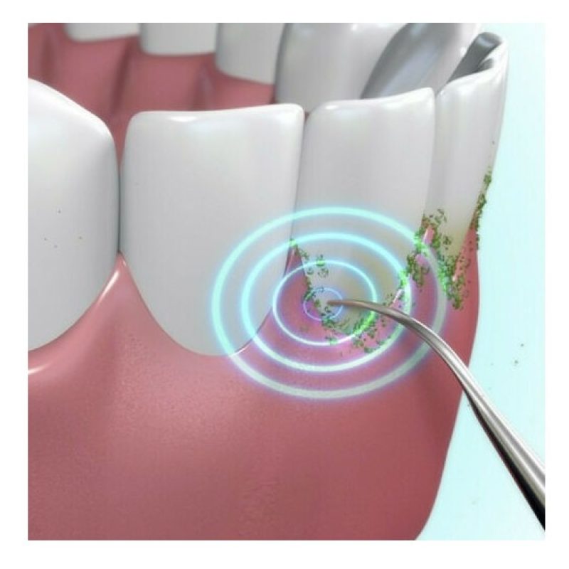 DOBO Sonic Pic Dispositivo Pulizia denti 3000 Vibrazioni Ablatore S...